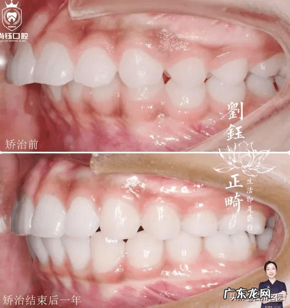 牙齿整形价格需要多少钱 牙齿整形一般多少钱啊