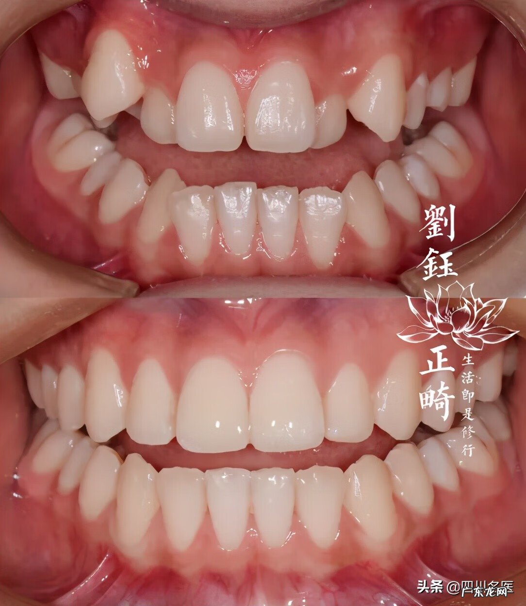 牙齿整形价格需要多少钱 牙齿整形一般多少钱啊