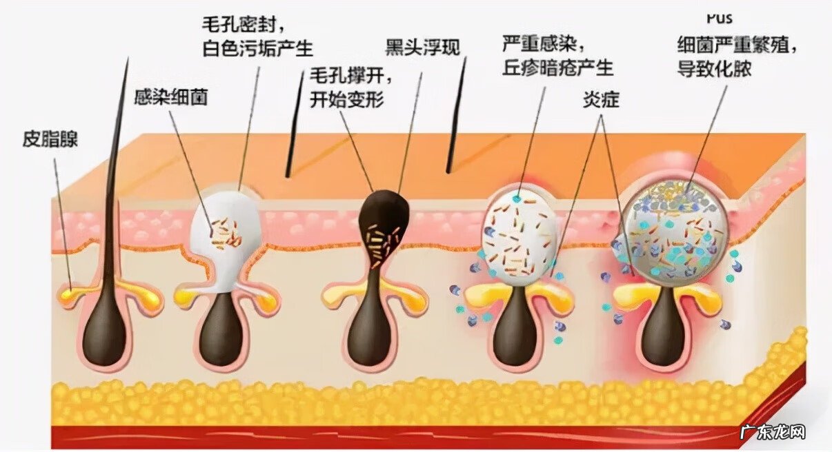 眼下皱纹怎么去除最有效 皱纹怎么去除最快