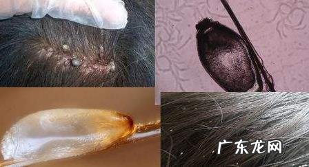 阴虱卵怎么有效清除 阴虱卵怎么消除