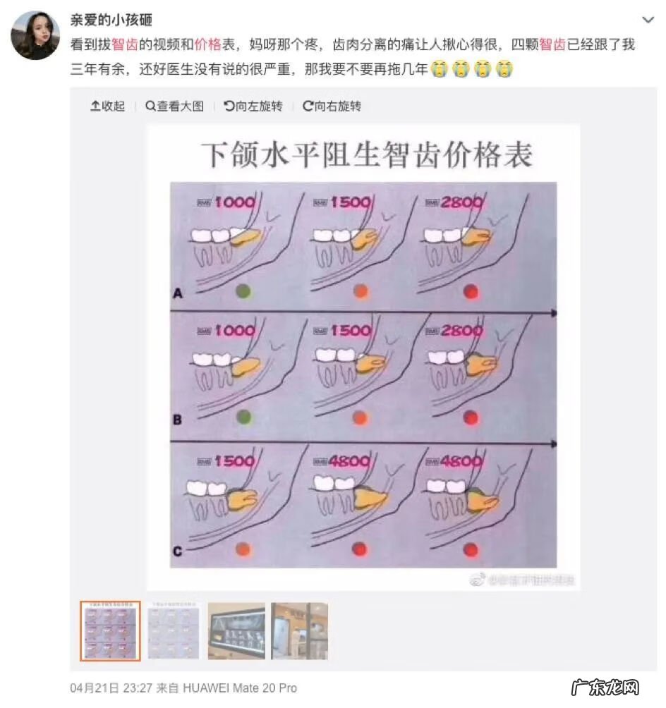必须拔掉的智齿图 拔智齿多少钱一颗