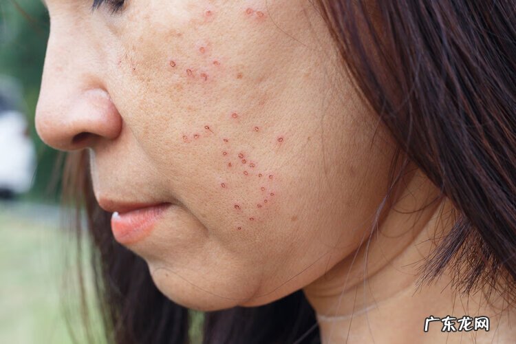 脸上长了个痤疮 脸颊长痤疮怎么回事