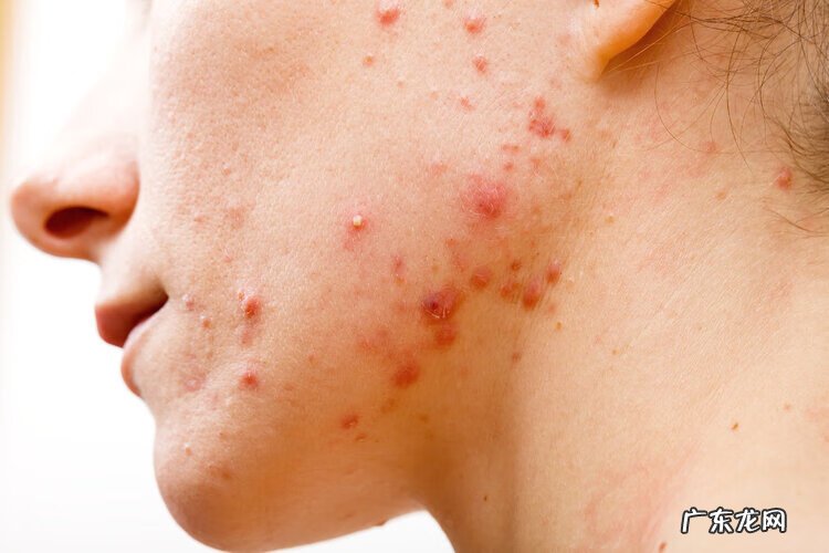 脸上长了个痤疮 脸颊长痤疮怎么回事