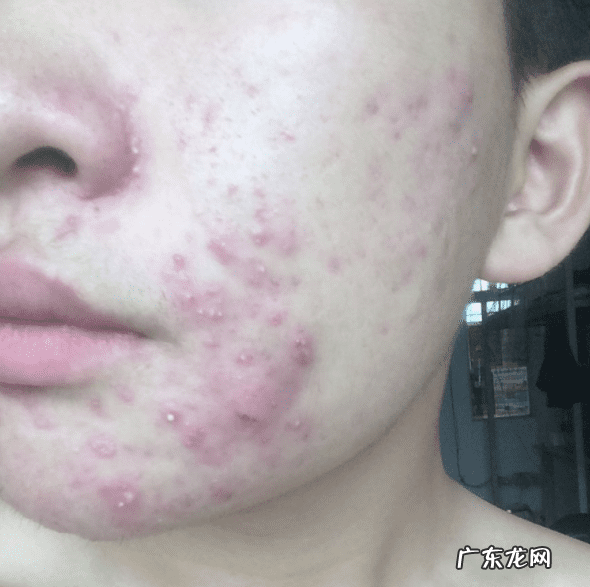 脸上长了个痤疮 脸颊长痤疮怎么回事