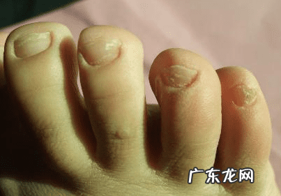 灰指甲的前兆图片 灰指甲是什么原因造成的图片