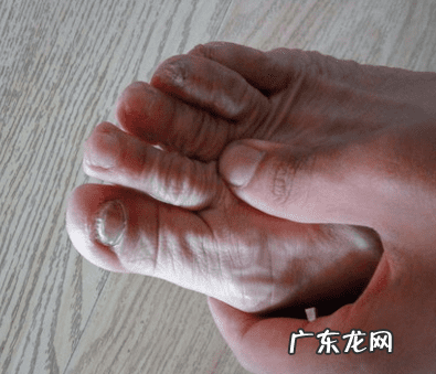 灰指甲的前兆图片 灰指甲是什么原因造成的图片