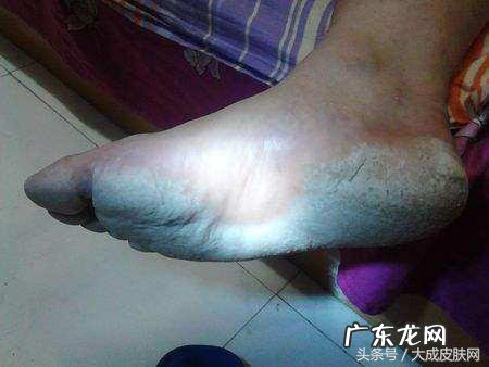 治脚气有啥偏方 治疗脚气的偏方有哪些