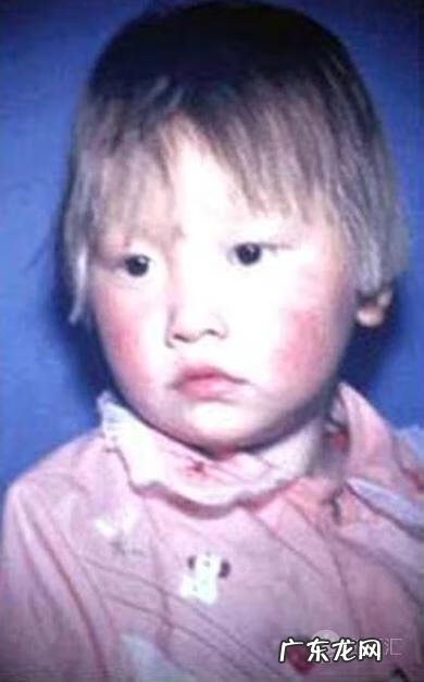 苯丙氨酸酮尿症是什么病 苯丙酮尿症是什么病