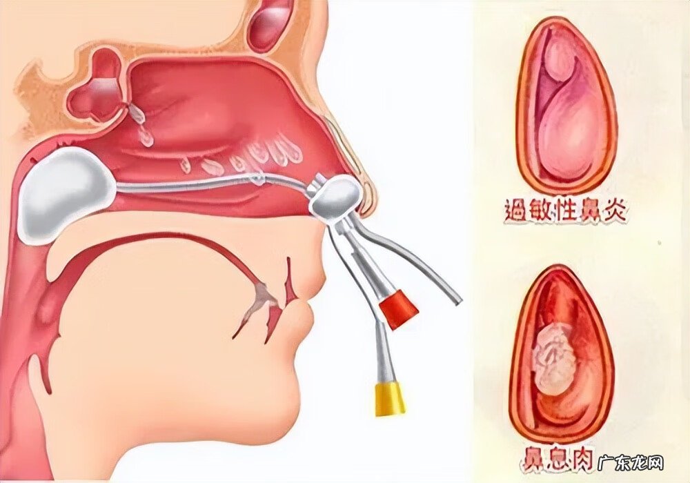 缓解鼻腔干燥的方法 鼻子干燥怎么办最快最有效