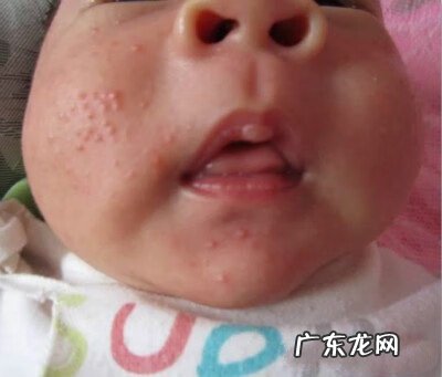 怎样解决脸过敏 婴儿脸上过敏怎么办