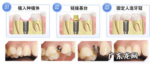 4000元的种植牙可靠吗 种植牙的十大危害