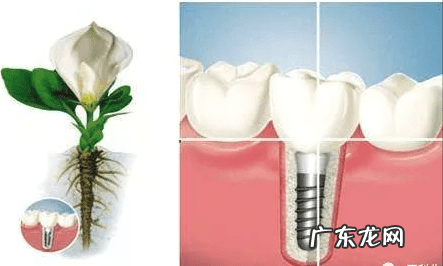 4000元的种植牙可靠吗 种植牙的十大危害