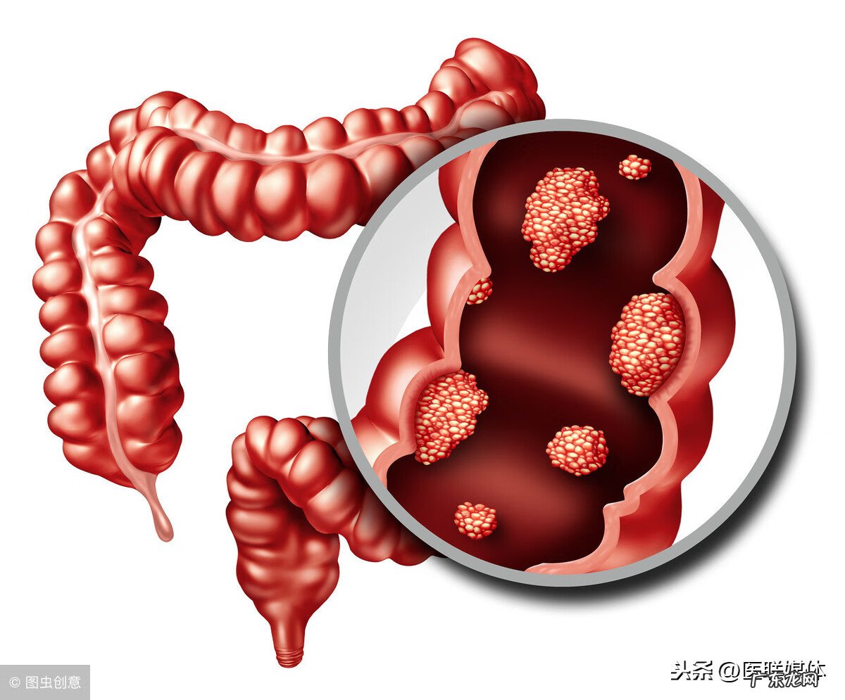 偶尔一次大便出血没事 大便偶尔出血是怎么回事