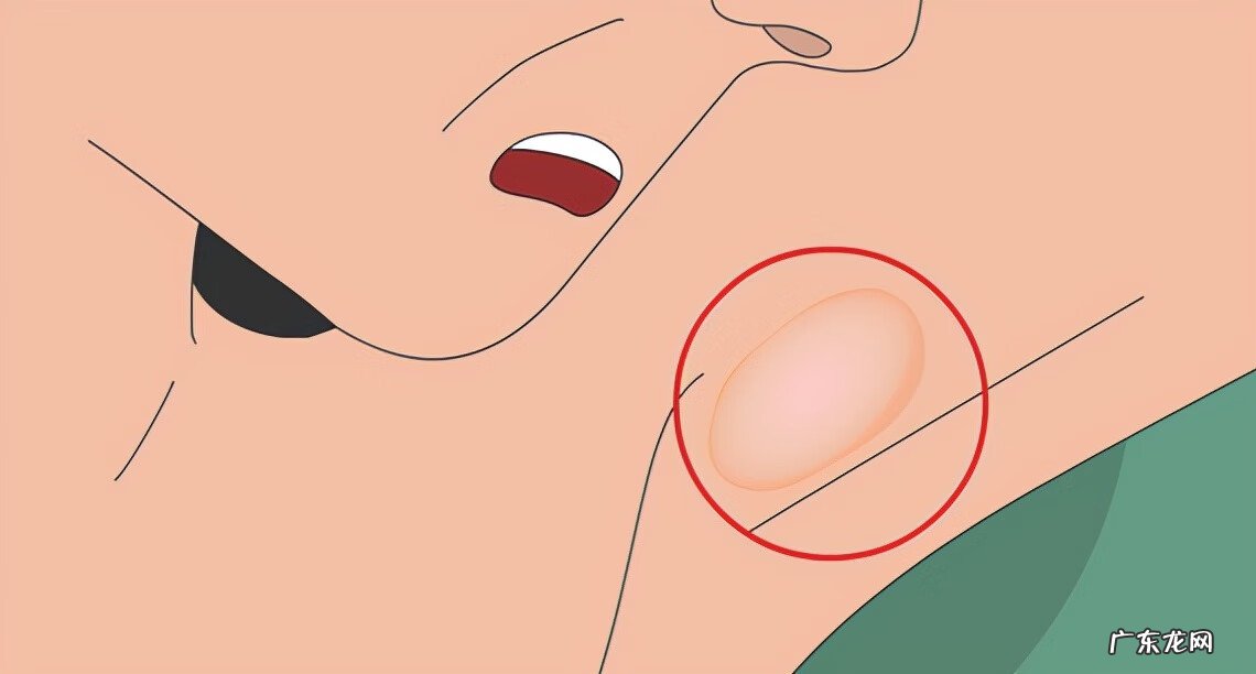 乳腺癌的十大早期信号 炎性乳腺癌症状