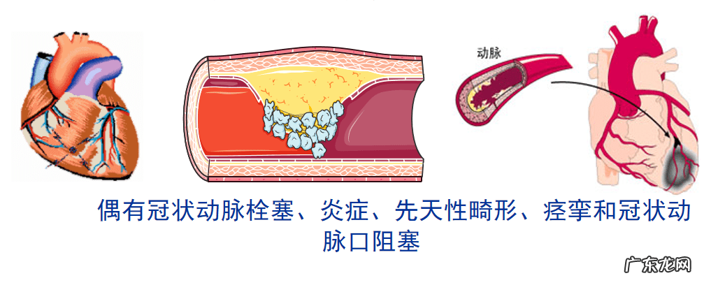 急性心梗的紧急处理 急性心肌梗塞什么原因引起的