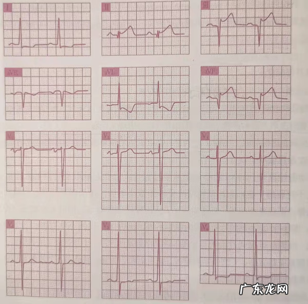 急性心梗的紧急处理 急性心肌梗塞什么原因引起的