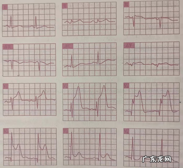 急性心梗的紧急处理 急性心肌梗塞什么原因引起的