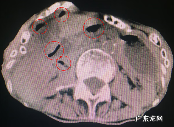 胃穿孔手术过程 胃穿孔手术要几个小时