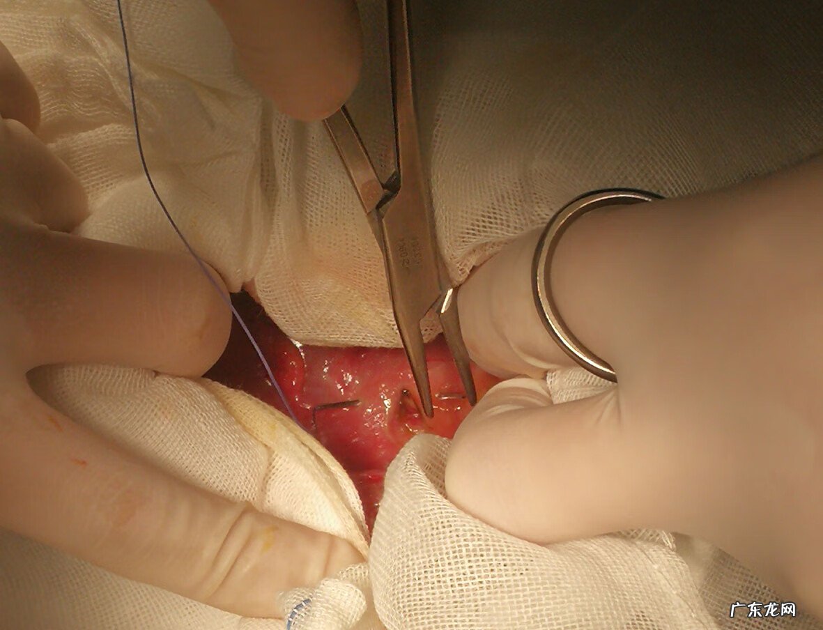 胃穿孔手术过程 胃穿孔手术要几个小时