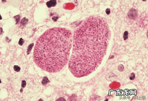 十大寄生虫病 寄生虫病症状