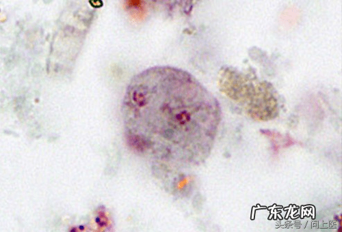 十大寄生虫病 寄生虫病症状