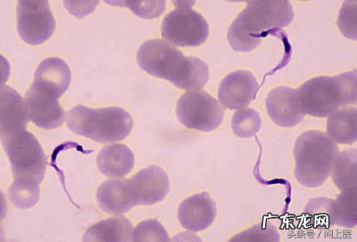 十大寄生虫病 寄生虫病症状