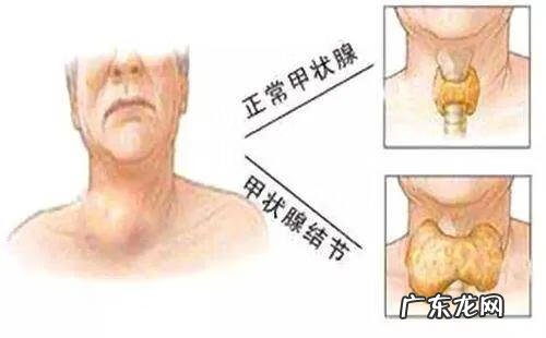 甲状腺肿大图片 甲状腺肿瘤严重吗