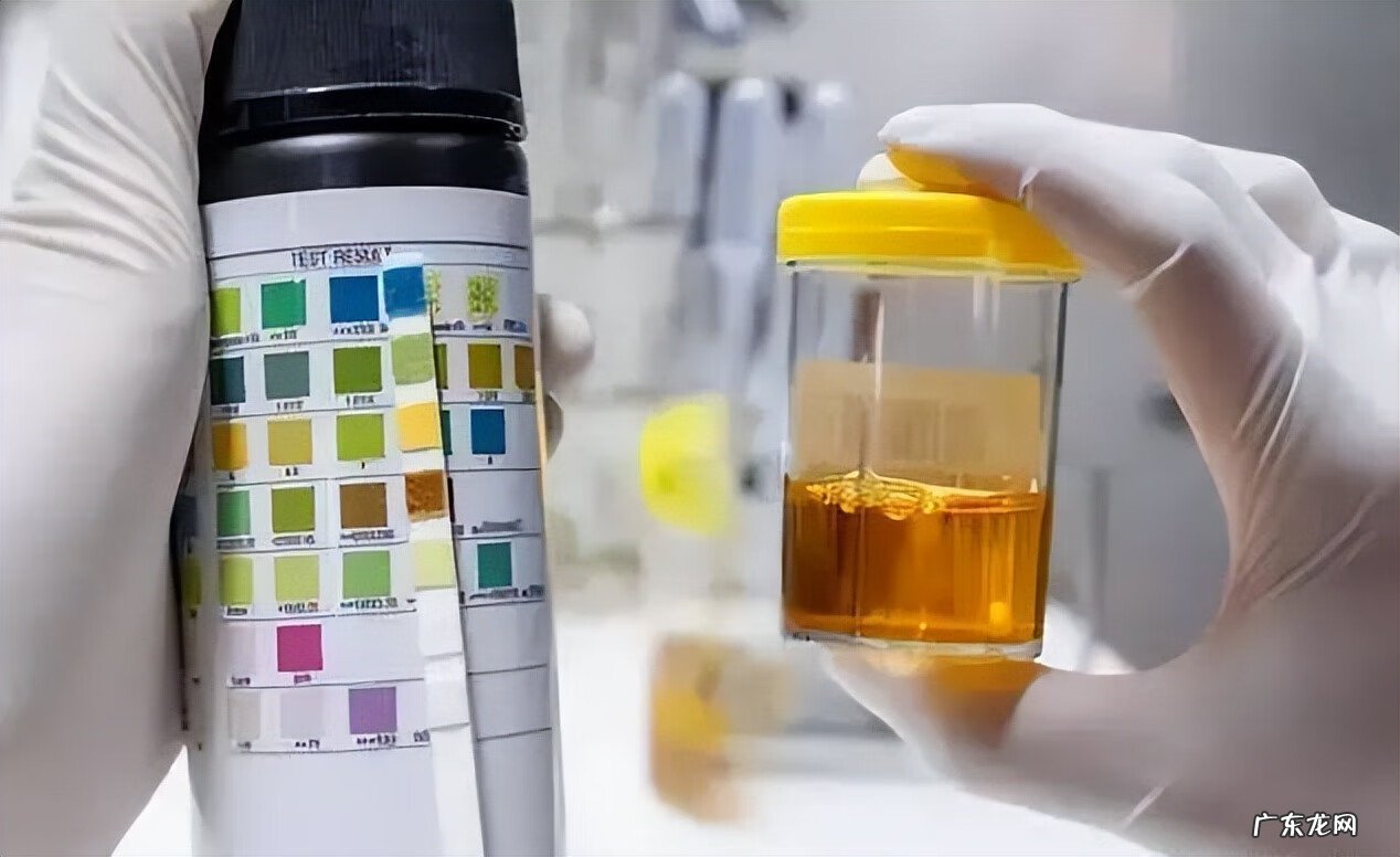 小便严重发黄是什么原因 最近小便黄是什么原因引起的