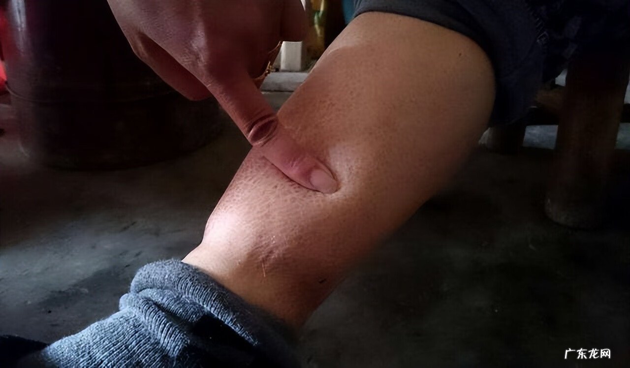 小便严重发黄是什么原因 最近小便黄是什么原因引起的