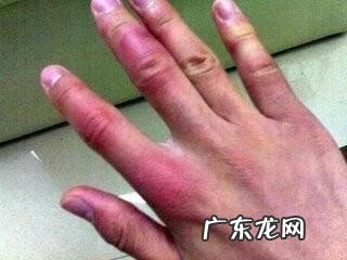 冻疮一直不好怎么办 长冻疮怎么办?