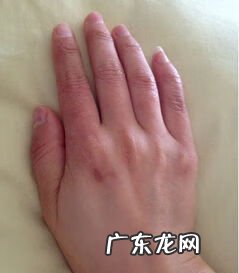 冻疮一直不好怎么办 长冻疮怎么办?