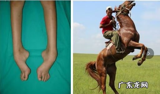 先天马蹄足是怎么引起的 先天性马蹄足图片