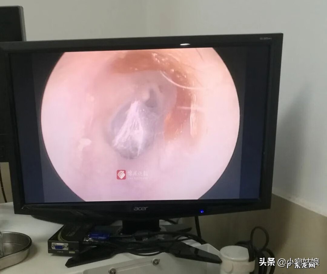 风水与耳朵的案例 耳朵里有虫子是什么症状