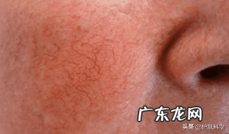 脸红血丝怎么快速消除 脸上红血丝如何去掉