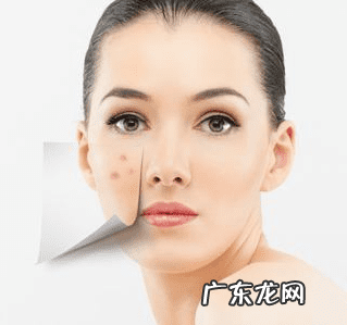 最近脸上老是长痘痘怎么办 脸上长痘痘要怎么办呢