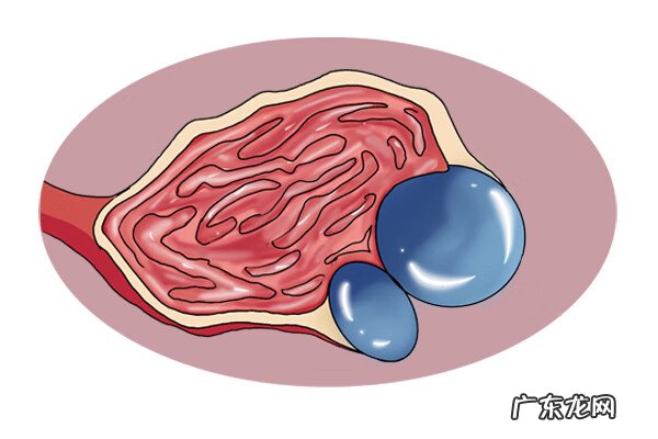 囊肿严重吗男性 囊肿严重吗?
