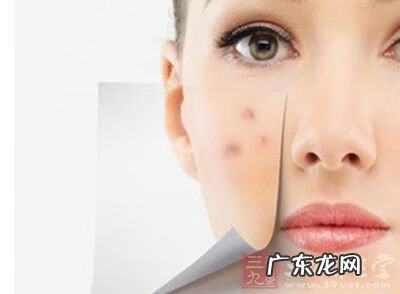 脸颊为什么会长痘痘 脸颊长痘对应哪个部位