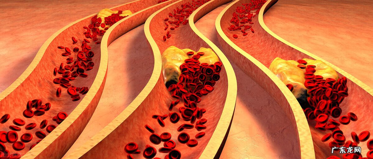 脑中风是什么意思 何谓脑中风