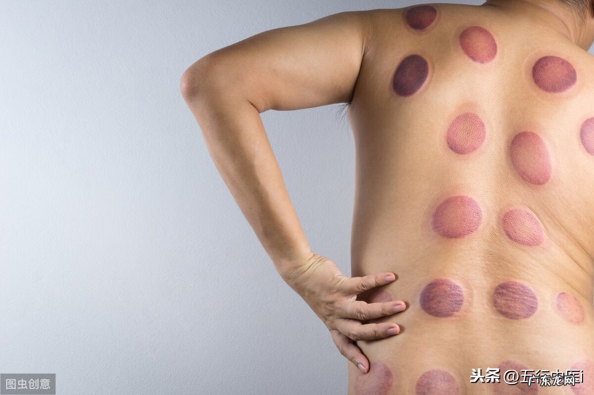 火罐疗法属于什么疗法 火罐疗法的操作步骤