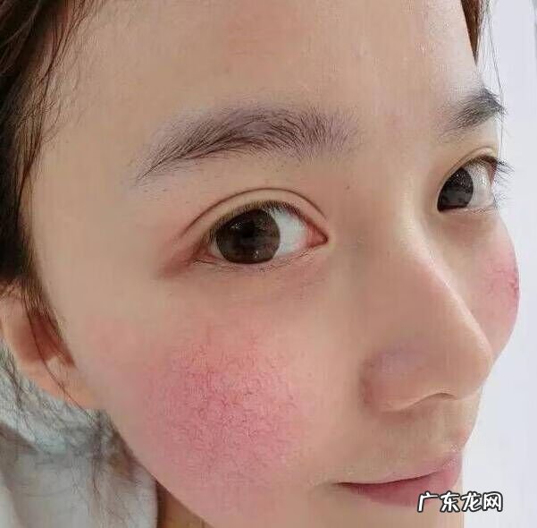 脸上好多红血丝怎么办 面部有红血丝怎么回事