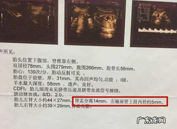 肾盂分离和性别有关吗 肾盂分离是什么意思