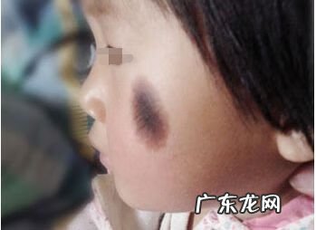 黑毛痣的毛能剪吗 黑毛痣要去除吗