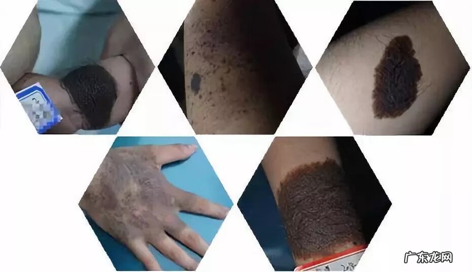 黑毛痣的毛能剪吗 黑毛痣要去除吗