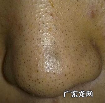如何清理黑头最有效 怎么才能彻底消除黑头