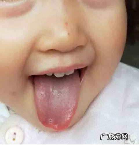 小孩反复感冒的中医辩证分析治疗