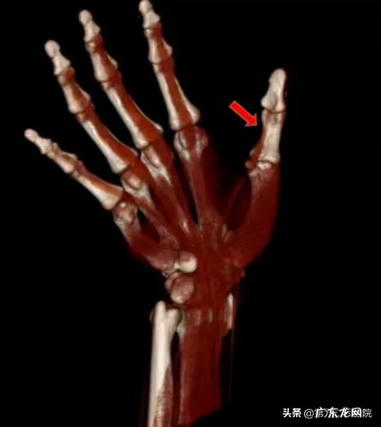 鬼影镰刀脚 镰刀割到脚怎么处理