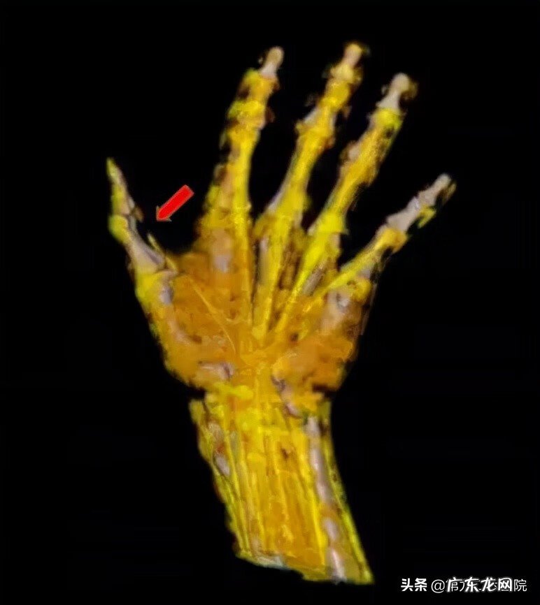 鬼影镰刀脚 镰刀割到脚怎么处理