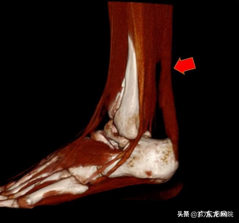 鬼影镰刀脚 镰刀割到脚怎么处理