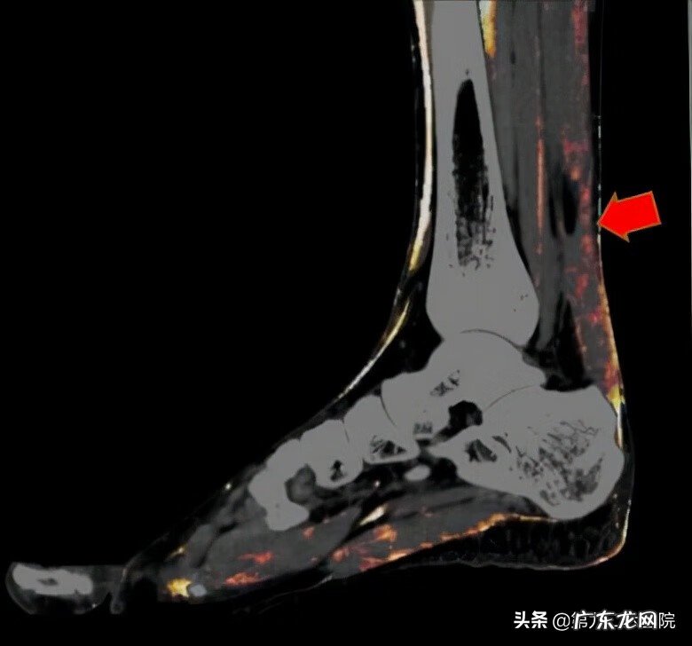 鬼影镰刀脚 镰刀割到脚怎么处理