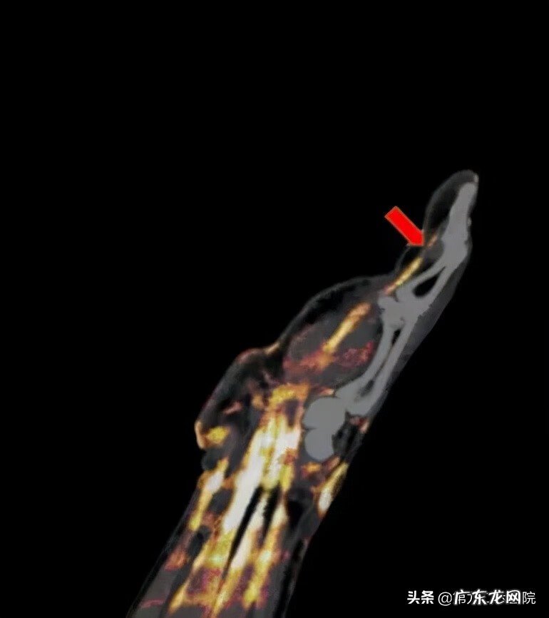 鬼影镰刀脚 镰刀割到脚怎么处理